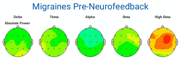 Migraines Pre-Neurofeedback