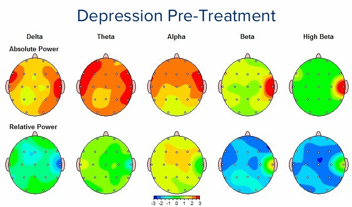 Depression Pre-Treatment